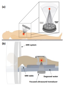an extracorporeal transducer for high-intensity focused ultrasound (HIFU)