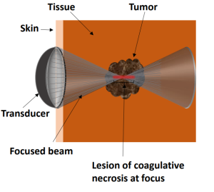 Figure 7: Schematic of the HIFU technology used for tumor therapy [34]
